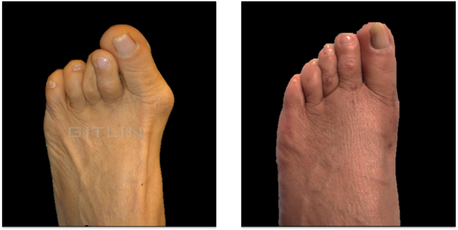 bunion5