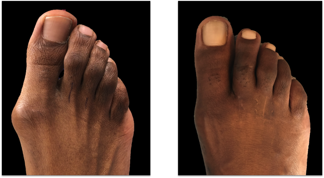 bunion9