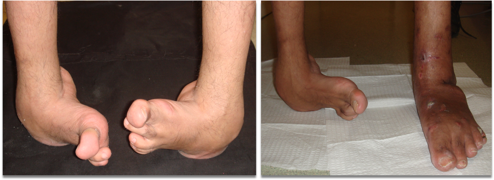 clubfoot1