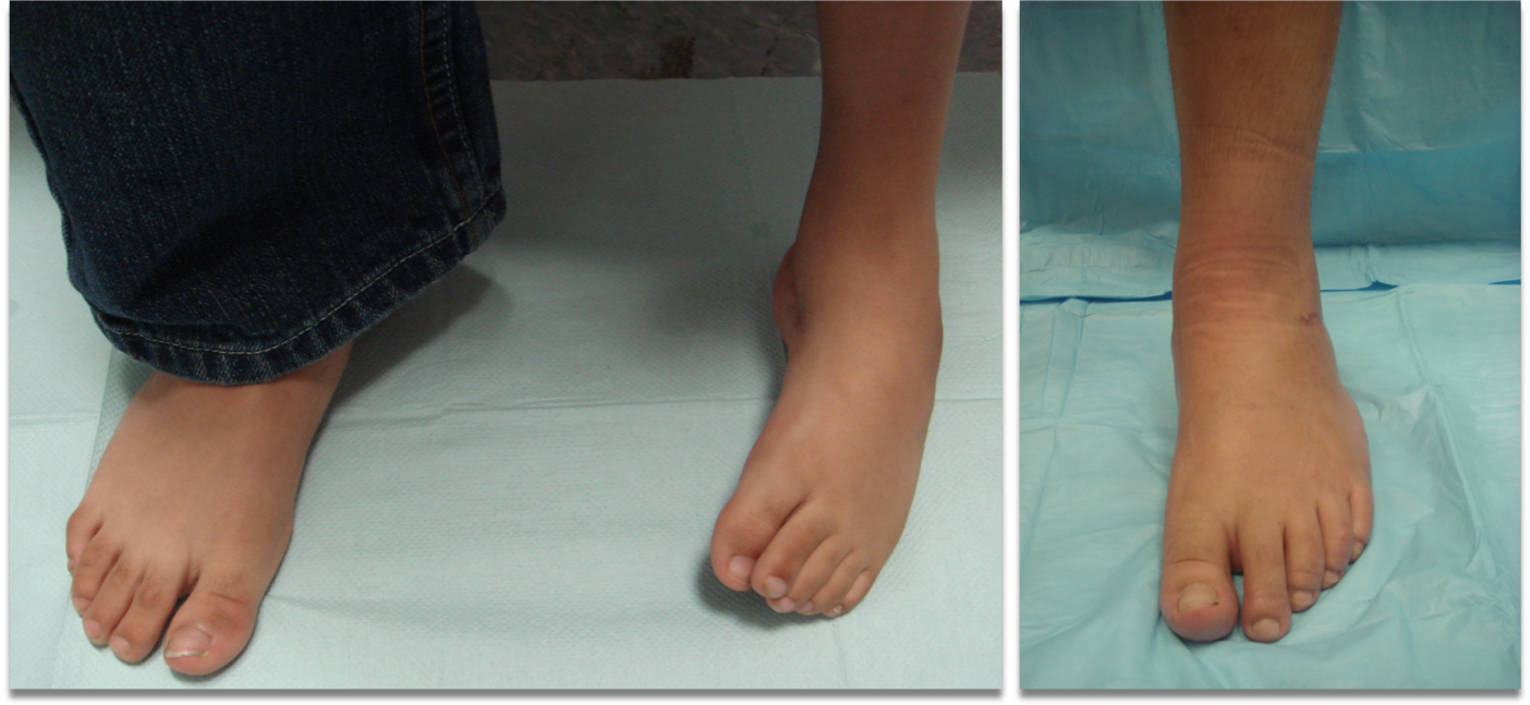 clubfoot8