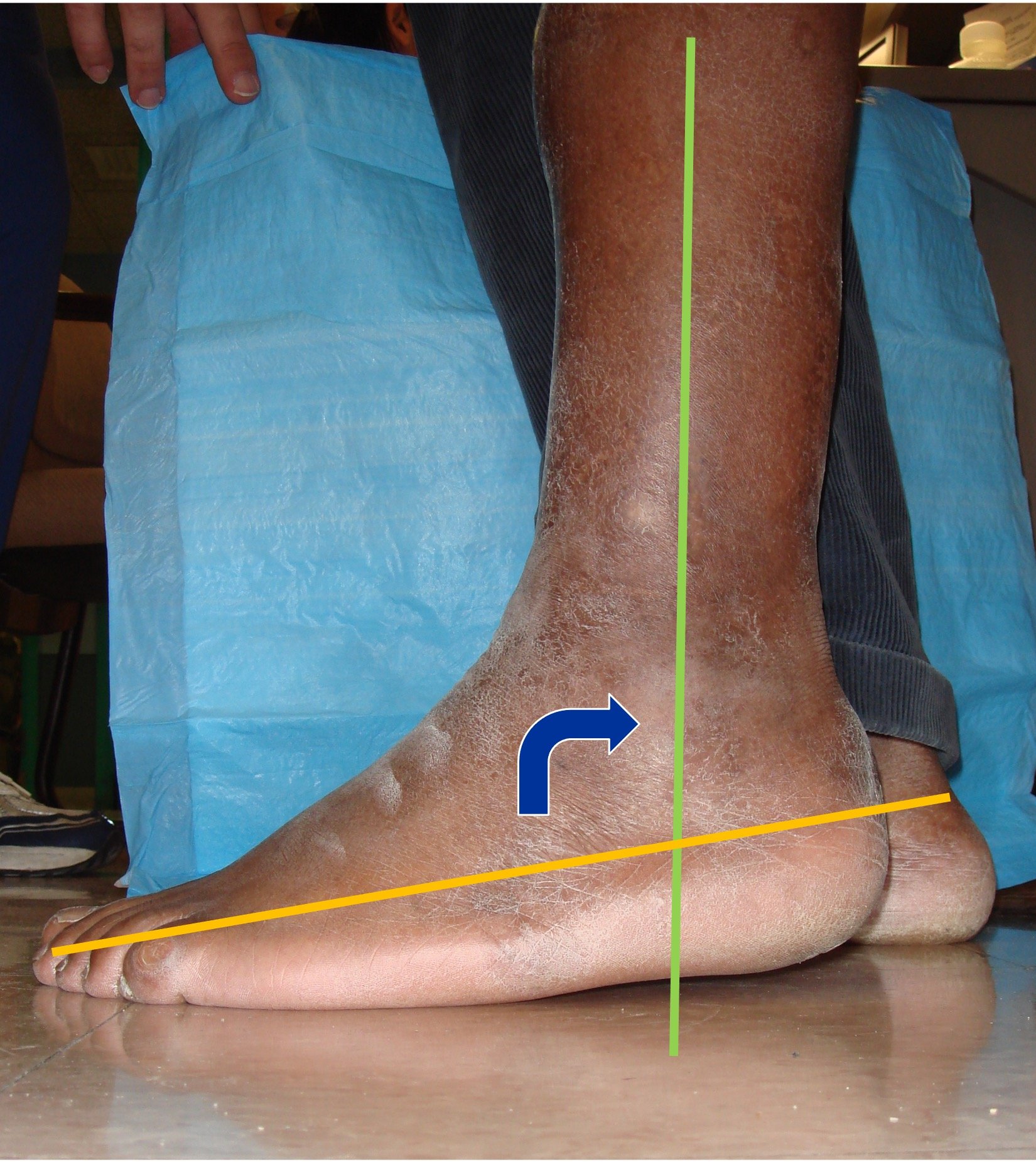 Equinus Contracture1