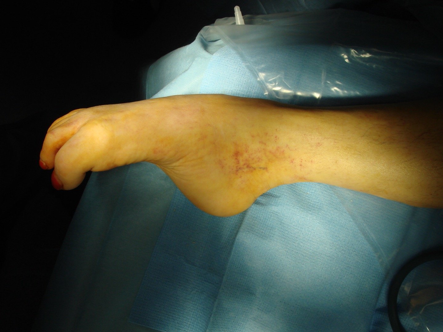 Equinus Contracture2