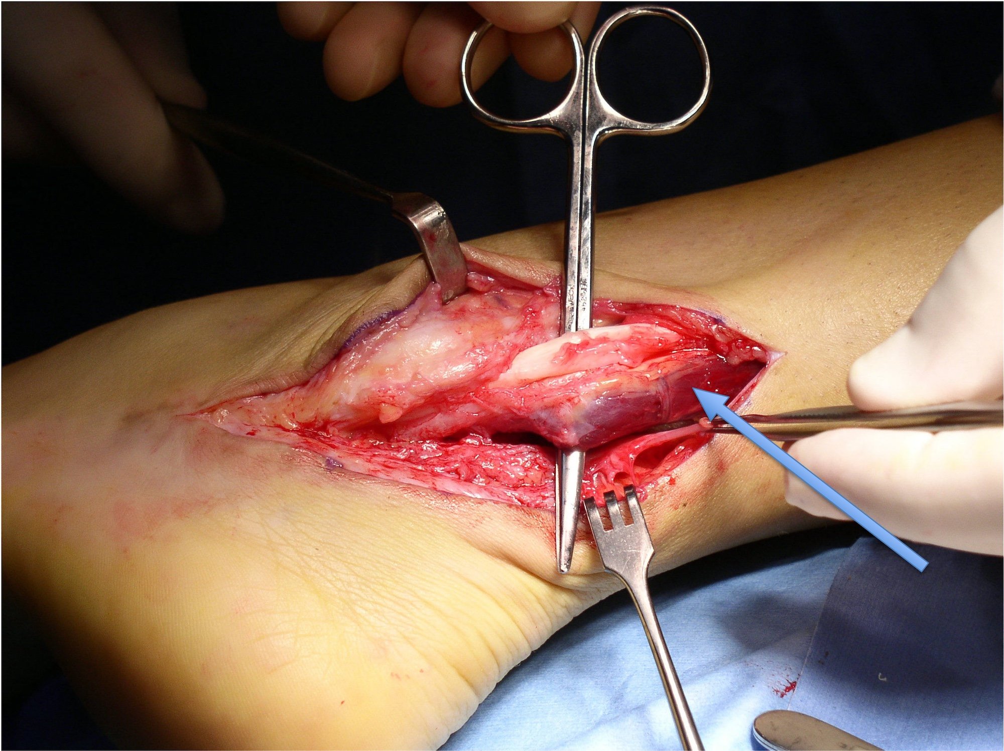 Peroneal Tendon Muscle