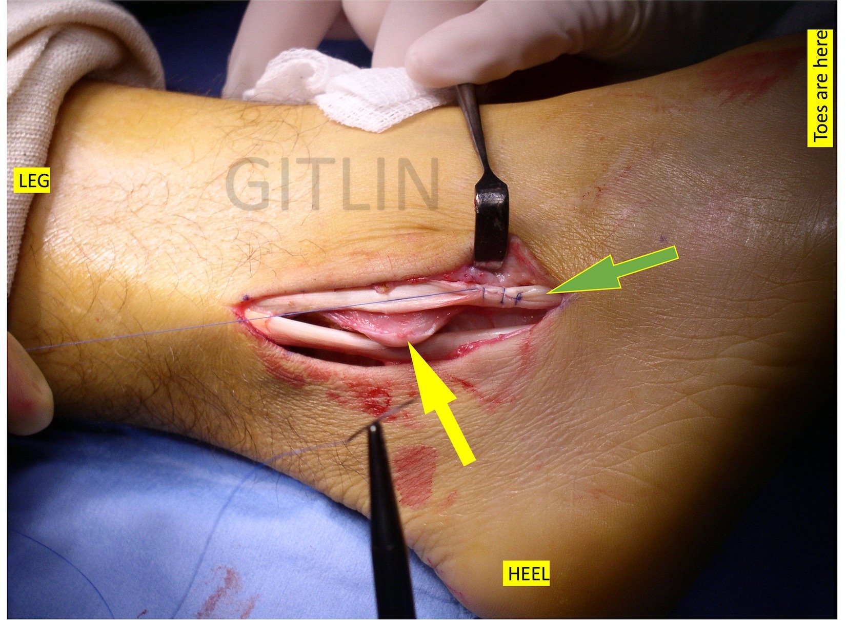 Peroneal Tendon Tubularization