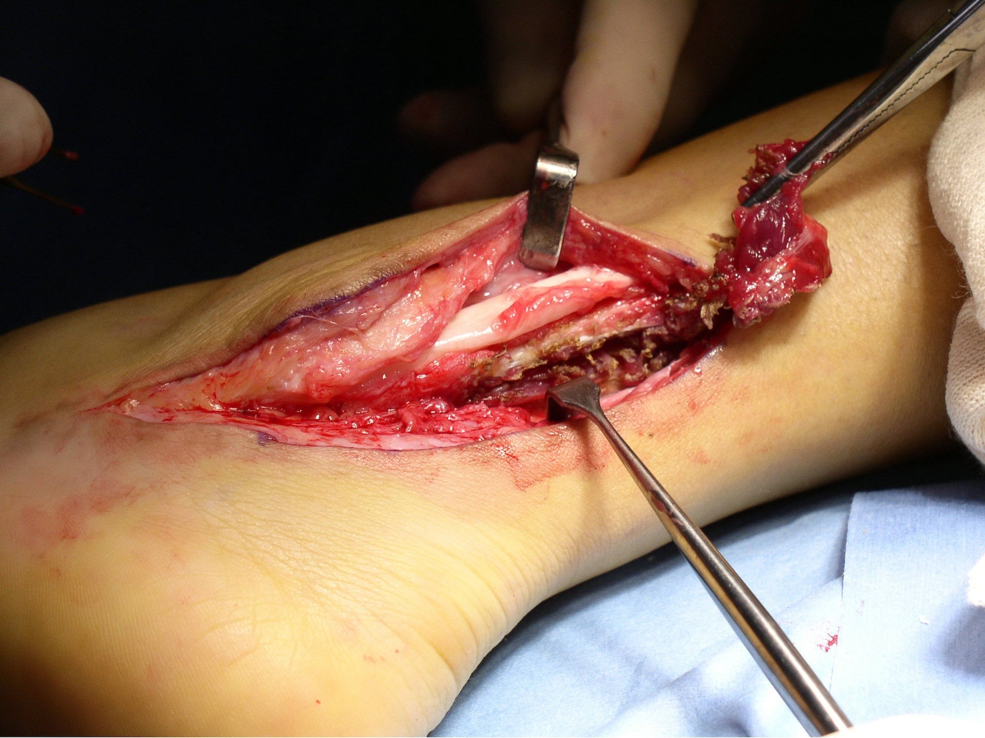 Removal Peroneal Tendon Muscle