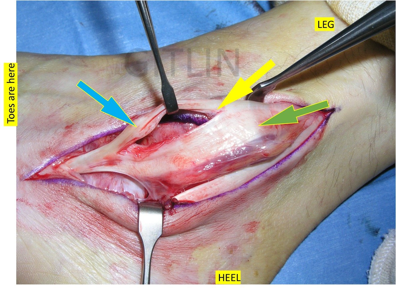 Split Peroneal Tendon With Calcification