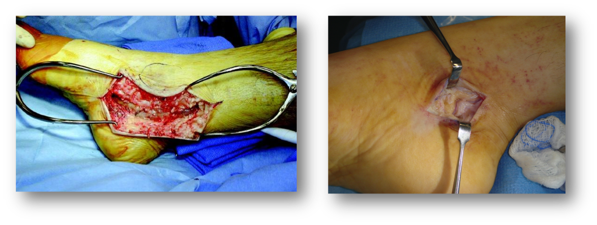 Tarsal Tunnel Syndrome